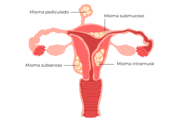 mioma uterino